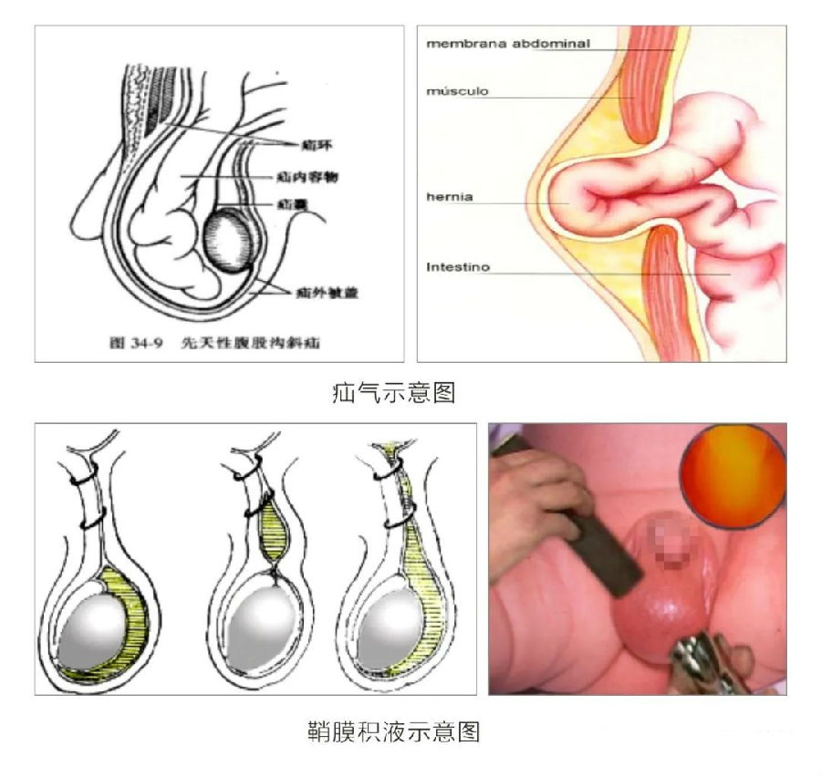 疝气.jpg