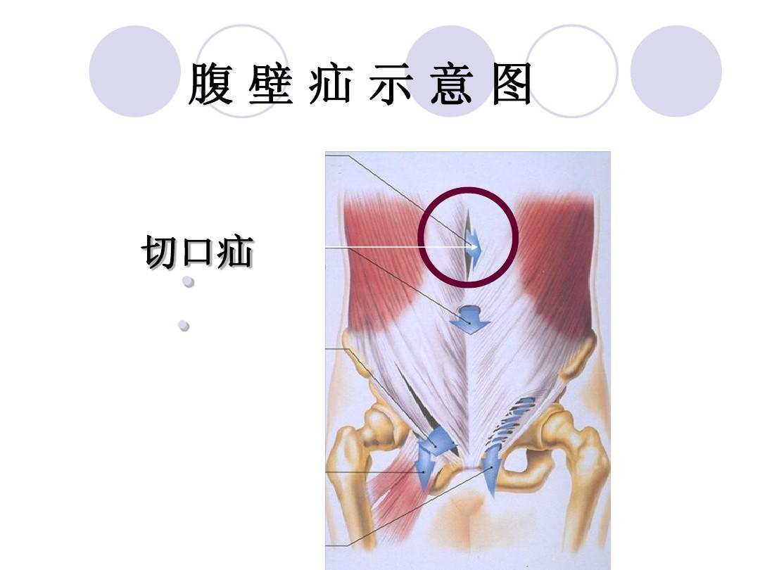 切口疝.jpg