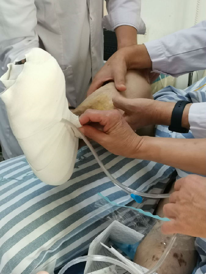 治疗静脉曲张、糖足、老烂腿等